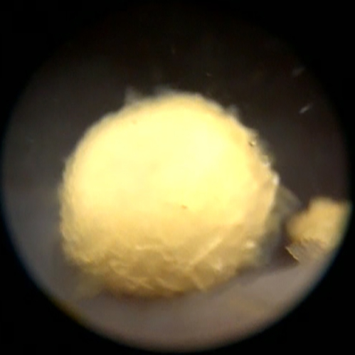 afbeelding Cystoscopie of scopie van de blaas