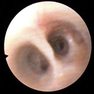 afbeelding Tracheobronchoscopie