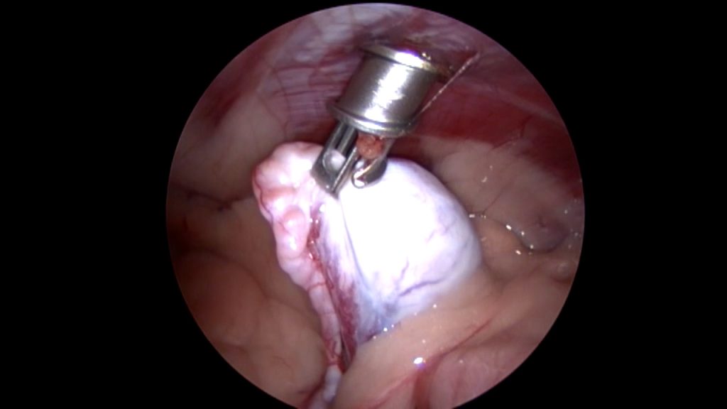 Dierenkliniek Tiel-Drumpt: Laparoscopisch geassisteerd opereren; Met een tang pakken we de binnenbal vast.