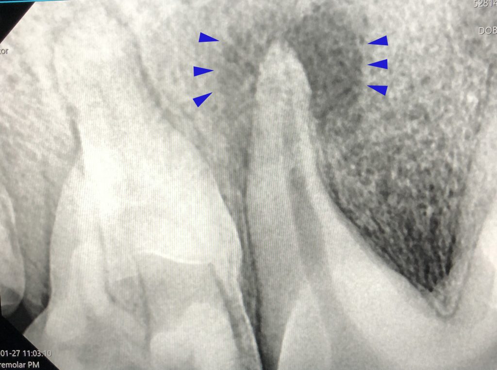 afbeelding Dentale röntgen