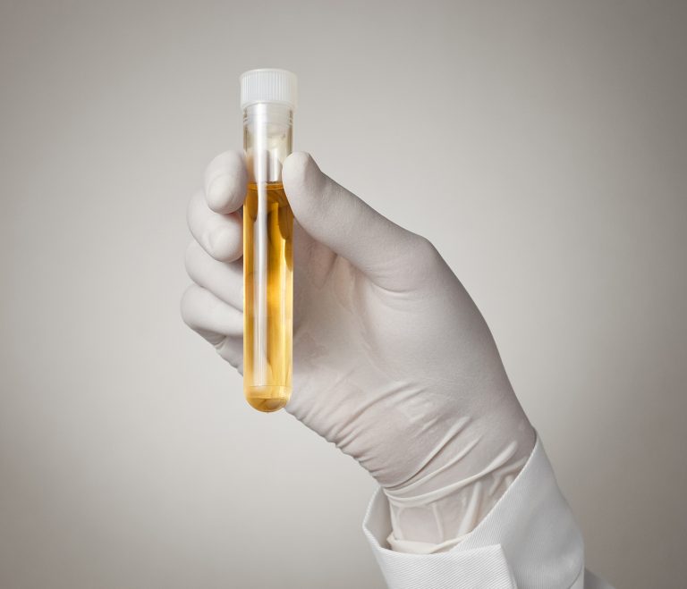 afbeelding Wat is een Dexamethason-suppressietest?